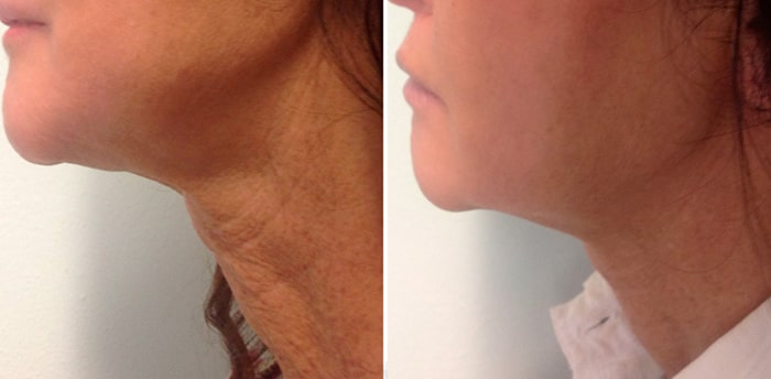 Le traitement laser Endolift pour le visage par le Docteur Sofia HERZI